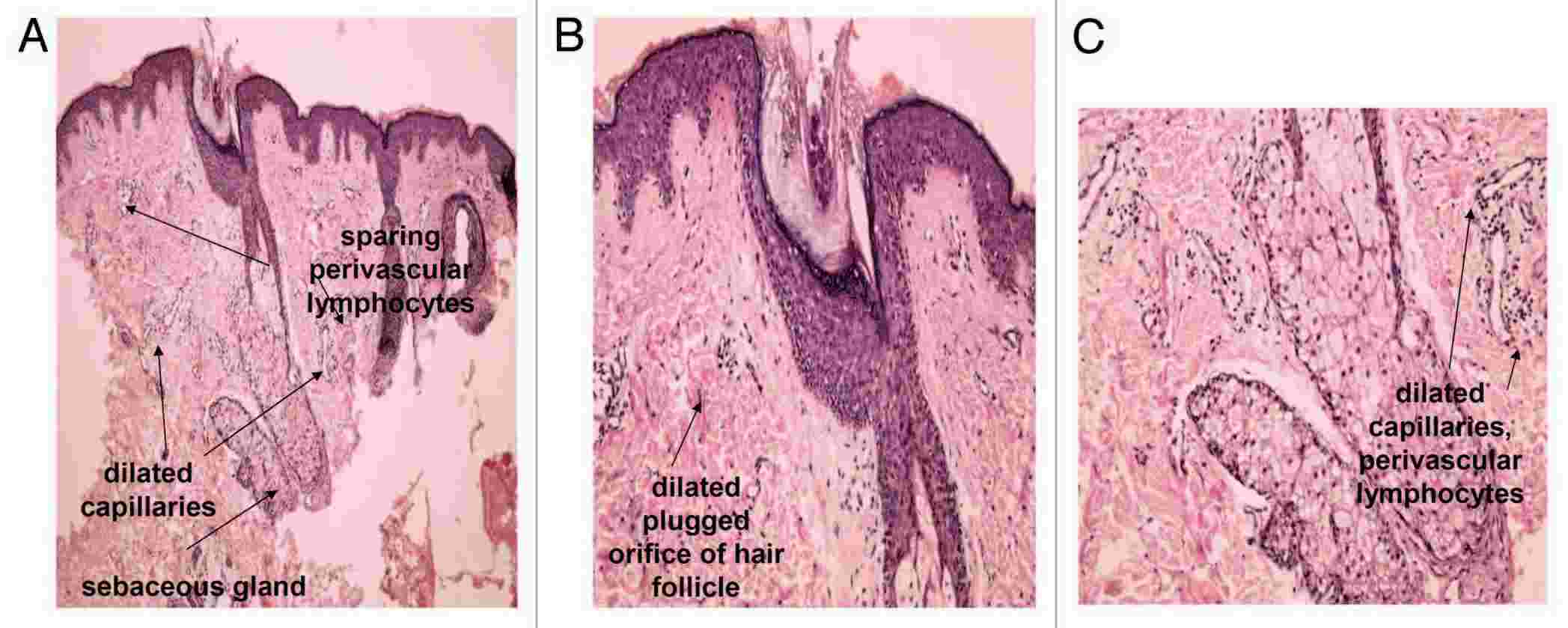 Fig.2 Genetic alterations implicated as fundamental factors in the pathogenesis of acne. (Makrantonaki, et al., 2011)